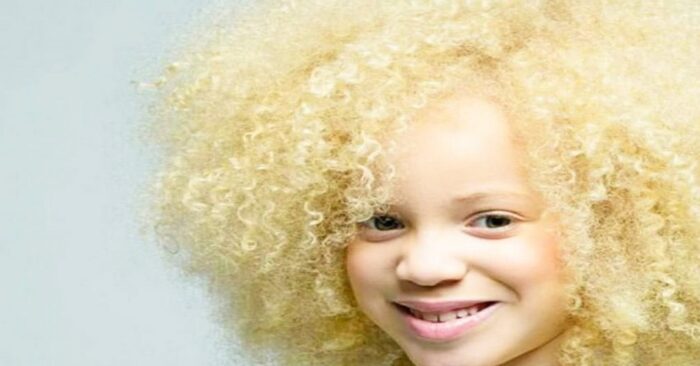  This African albino girl has a unique appearance: this is how she turned her beauty into dignity