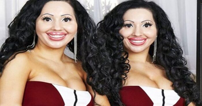  Twin sisters got an identical $250,000 makeover: this is what they looked like years ago