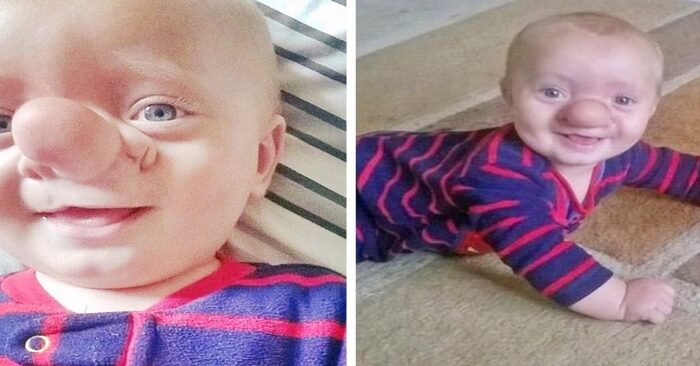  This baby reminds people of “Pinocchio” because of his appearance: here’s what he looks like now