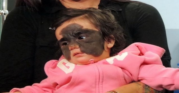  This wonderful baby was born with a special mark on her face, fortunately she was finally cured