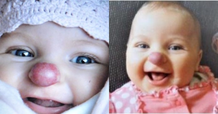  When this girl was born, she looked like a little clown, with a red mark on her nose: she has become like that now