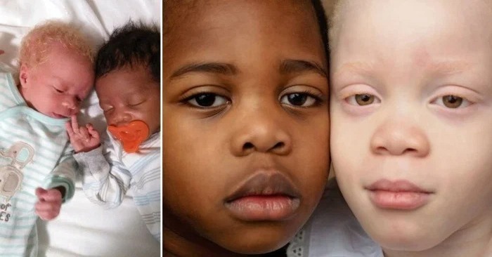  Unexpectedly amazing story: this woman gave birth to twins with different skin colors