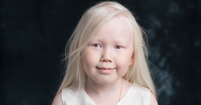  Real snow white: this unique albino girl gets the attention of all modeling agencies