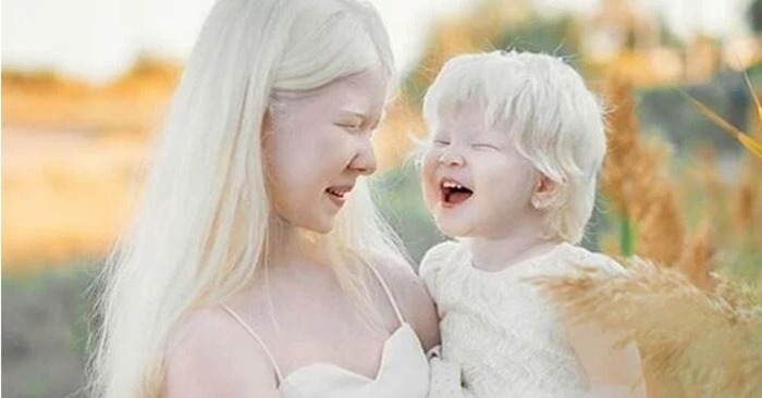  What a unique thing life is: this is how a family lives in which albino sisters were born