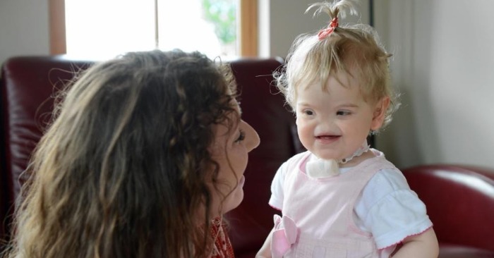  This baby was born without a nose: this is what a girl who had aplasia looks like
