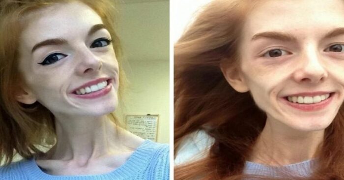  Interesting story: a simple bar of chocolate helped this girl with anorexia to recover