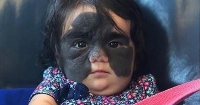  Already living without a huge spot: the girl who was born with a rare skin disease is already healthy