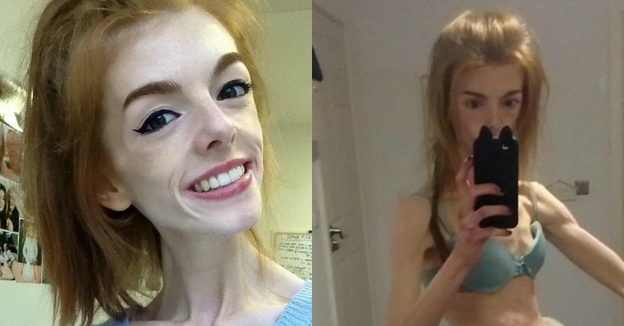  Simple chocolate helped her recover: the girl was sick for two years by anorexia and weighed only 29 kg
