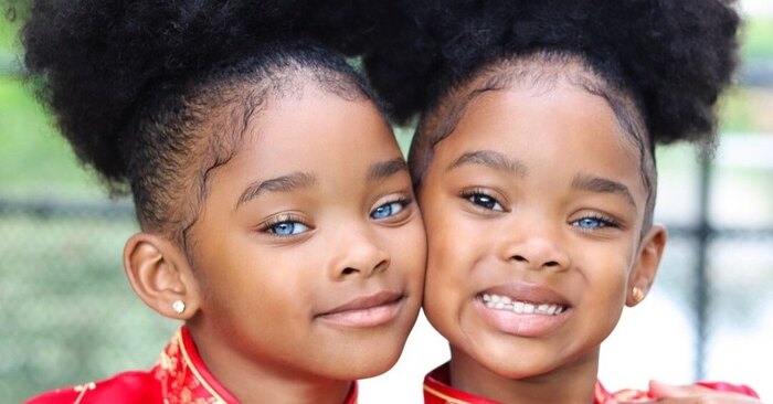  “It’s has been 12 years”, this is what look like twins with the different color of eyes