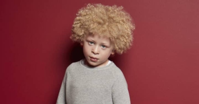  Inspiring Story: Albino Boy’s Path to Confidence and Success in Modeling