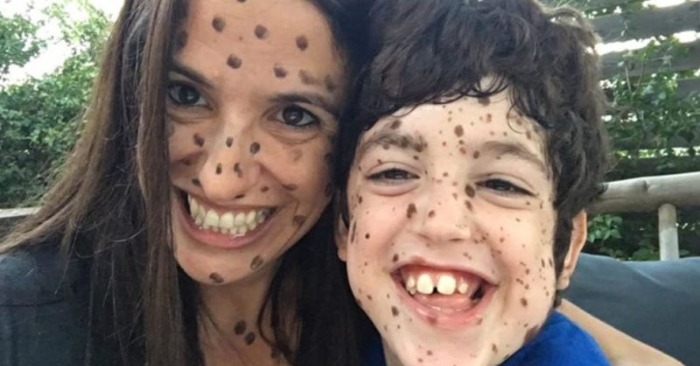  From Ridicule to Unity: The Viral Movement Inspired by a Boy’s Birthmarks
