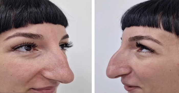  «Rhinoplasty changed her whole life!»: The way this lady transformed after rhinoplasty will surprise everyone