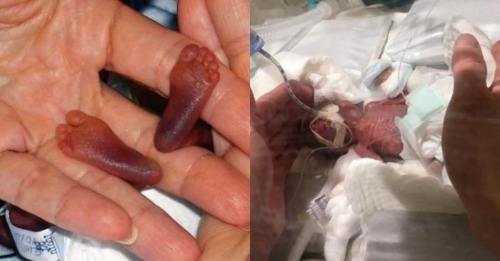  «Was born with the size of onion!» No one believed that this baby would survive but the unexpected happened