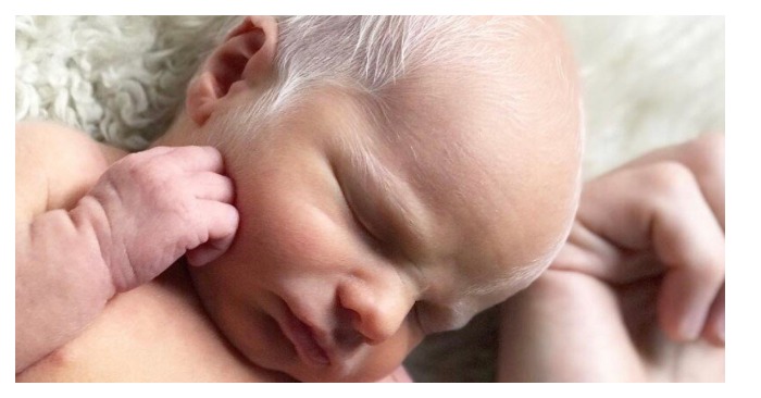  «A future supermodel!» What the baby boy with albinism looks like now sparked reaction