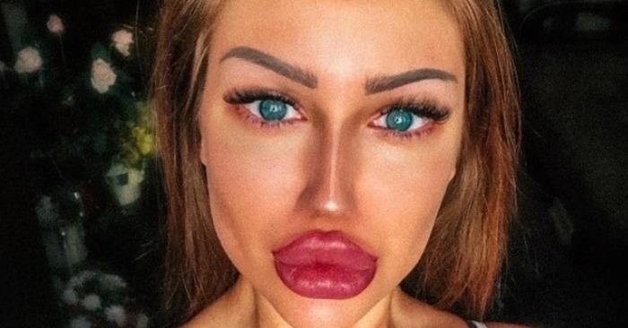  «From a sweetie into a human waxwork!» The disastrous cosmetic surgery journey of this girl caused a furor