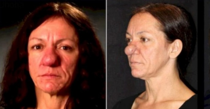  «Pinocchio is real!» The woman «survives» with a huge nose until she meets a surgeon who changes her life forever