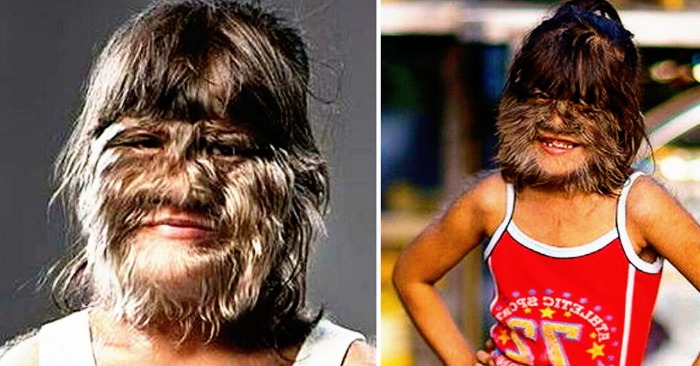  «The hairiest female in history!» Here is the girl with abnormal hairiness who appeared in the Guinness Book of Records