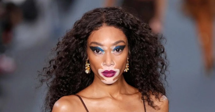  People called her a «cow»! Winnie Harlow with vitiligo responds to criticism and sparks reaction
