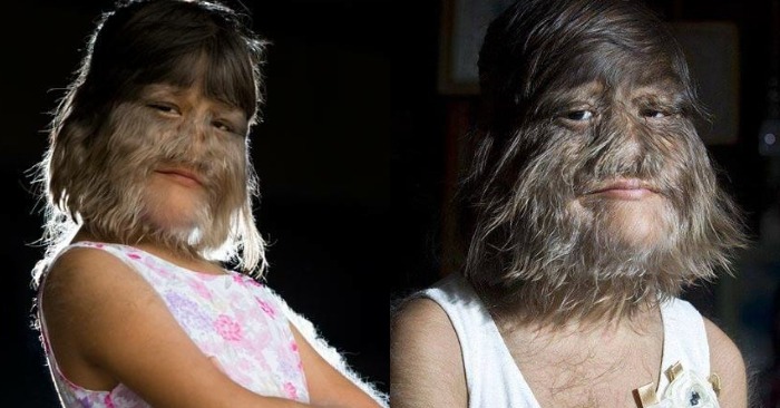  «The hairiest girl in history!» This is what happened to Guinness Book Record holder Supatra Sasuphan